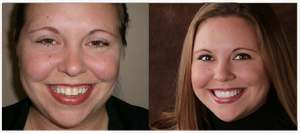 Shelby Township Dentist - Before and Afters