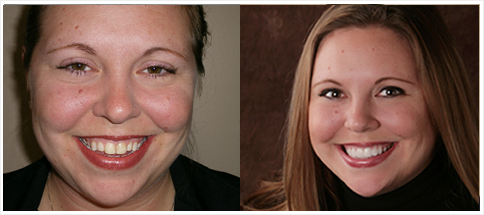 Shelby Township Dentist - Before and Afters