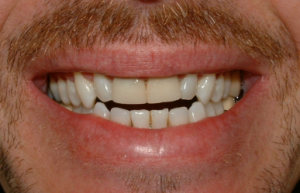 Dentist for Rochester Clients Discusses Veneers