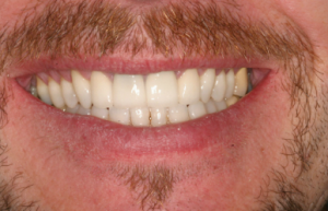 Veneers - Explained by Dentist in Utica, Michigan